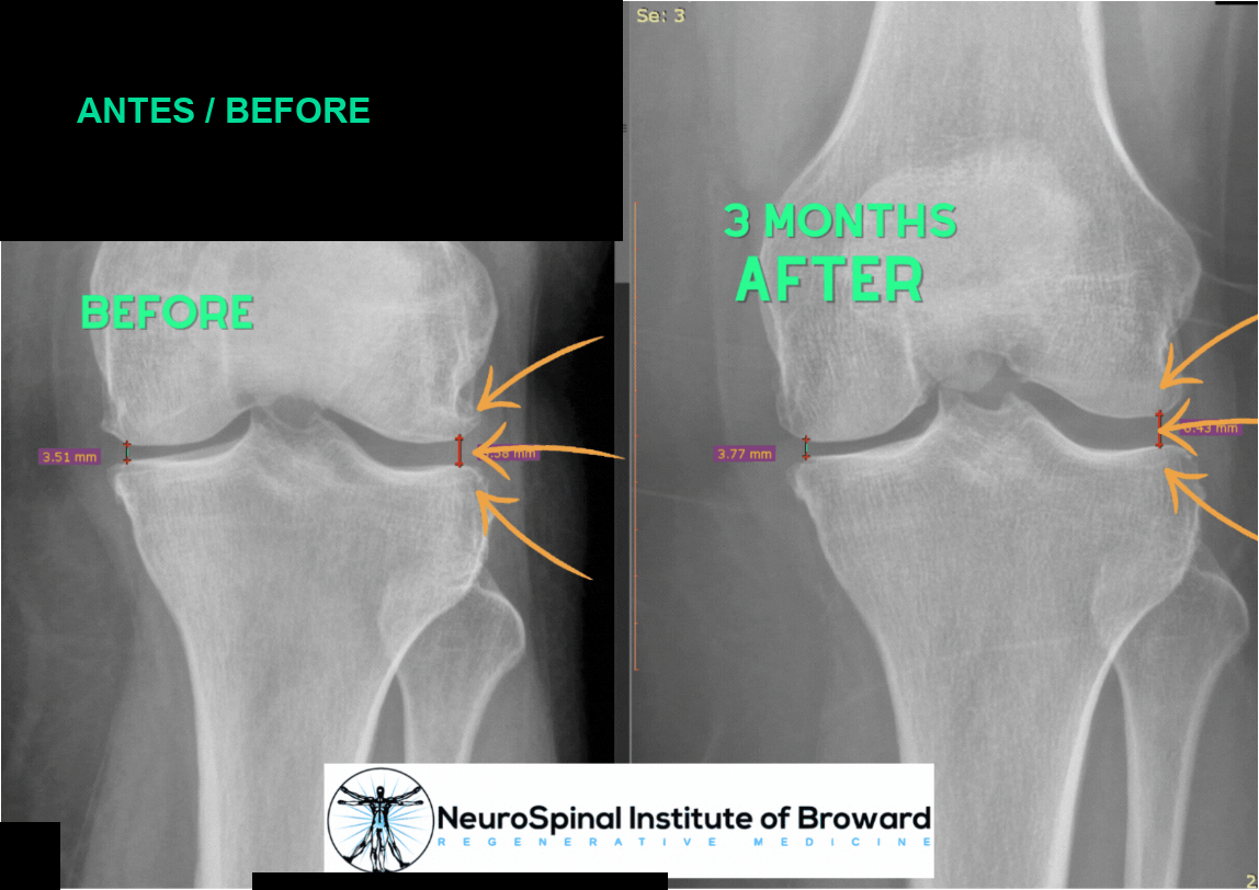 Knee X-rays before and three months after, with personal identifiers covered